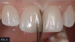 translucent lingual enamel layer, Evanesce Enamel Clear