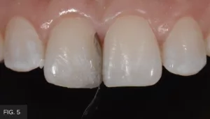 opaque composite, fracture line