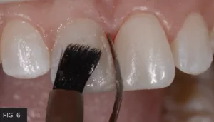 final composite layer, Evanesce A1U, facial surface