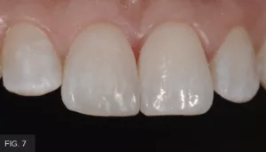 Immediate post-op, Class IV restoration