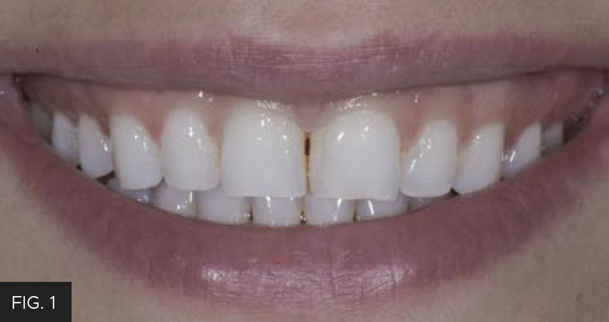treatment, flat front teeth