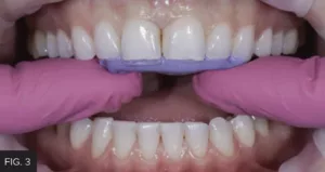 lingual matrix, establish lingual contours,incisal edge locations