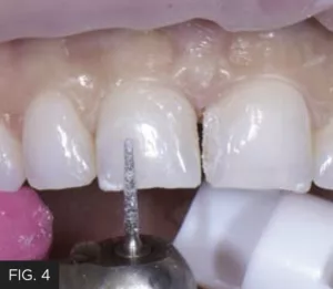 starburst bevel, facial surface