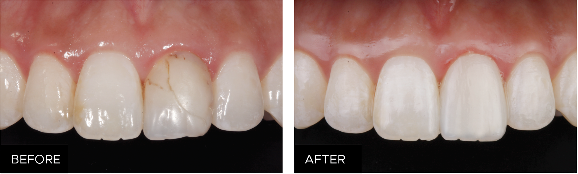 restorative clinicals, before & after