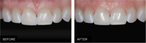 restorative clinical, before & after