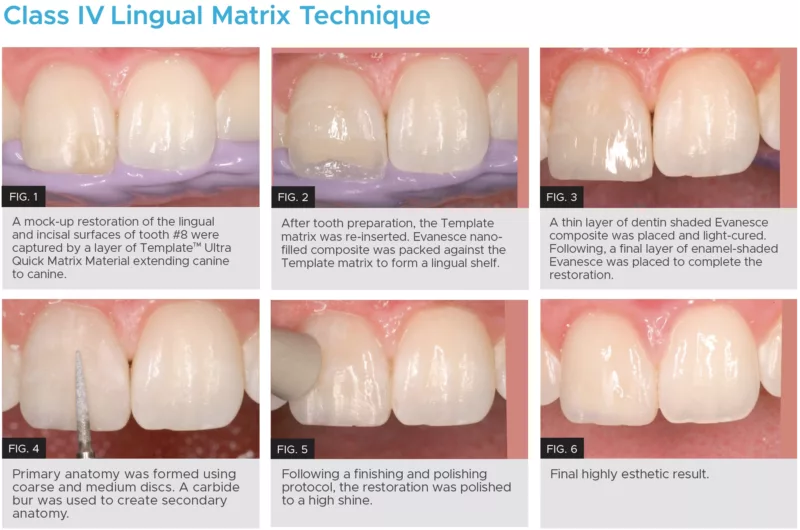 Class IV lingual matrix technique clinicals