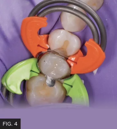 Evanesce A3U composite, sectional matrix, occlusalcontour