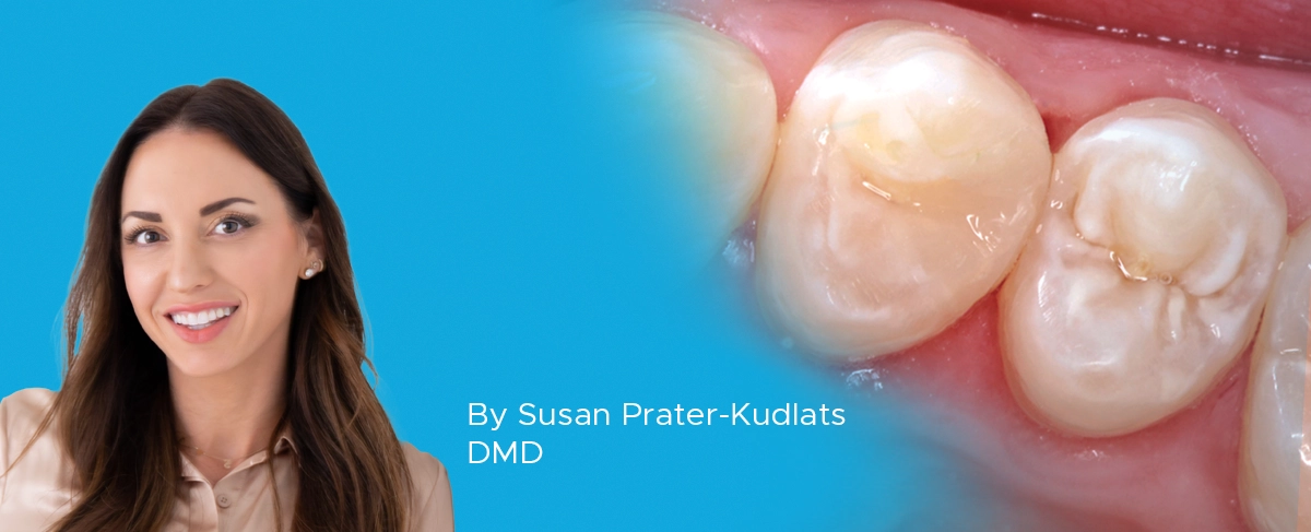 Dr Susan Prater article banner Class II DualForce Sectional MAtrix System