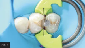 DualForce Sectional Matrix System