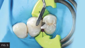 Evanesce composite sculpted to preparation, Composite Ninja instrument, DualForce Sectional Matrix