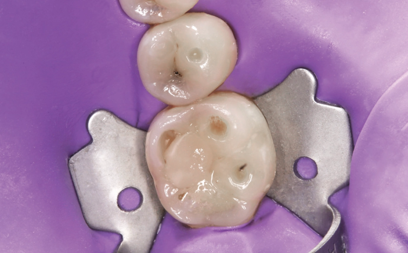 dental dam isolation clinical