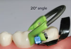 article image DualForce molar ring 20 degree angle