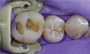 Dr. Mennito True Dam isolation article FIG 3