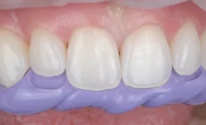 clinical, lingual matrix, Template