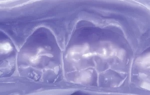 clinical image, Template matrix material, dental impression