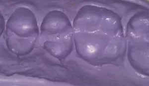 clinical impression Template matrix material