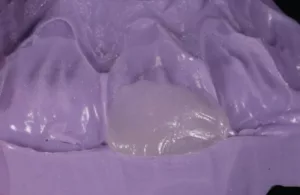 clinical, lingual matrix, Template