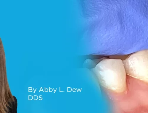 Cementation Protocol Using Cling2 Resin Optimized Temporary Cement