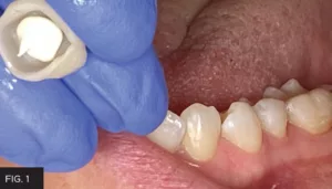 temporary cement injected crown