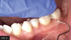 temporary crown seated