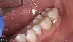 temporary crown seating