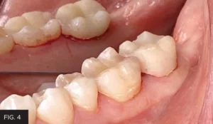 temporary crown seating, clinical image