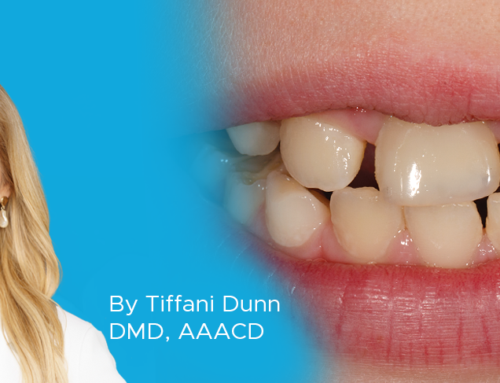 Creating Natural Restorations for Pediatric Trauma Teeth