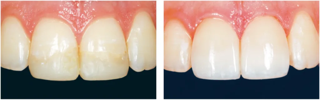 clinical image, restorative, Evanesce Silk composite
