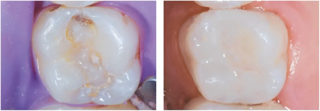 clinical image, restorative, Evanesce Silk composite