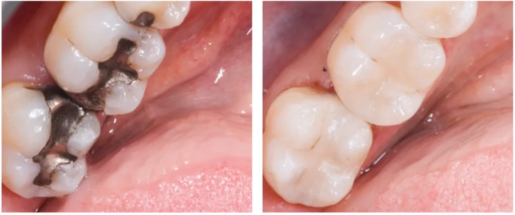 clinical image restorative, Evanesce Silk composite