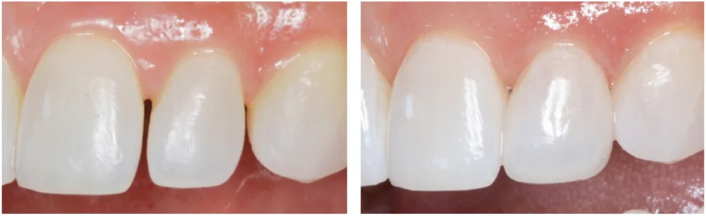 clinical images restorative Evanesce Silk composite