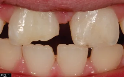 clinical image, fracture tooth #8, tooth #9