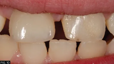 clinical image, final restoration, tooth #8