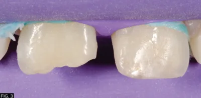 clinical image, isolation, True dental Dam