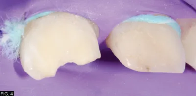 clinical image, tooth #8, tooth#9, restoration