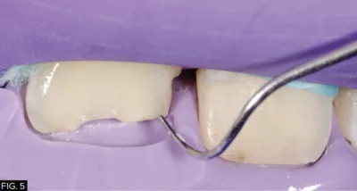 clinical image, restoration, Template matrix 