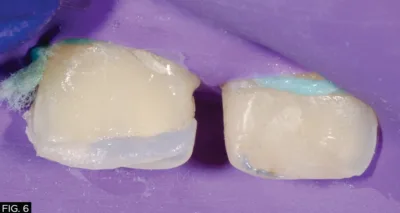 clinical image, restoration, lingual shelf