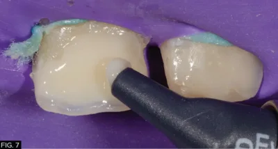 clinical image, restoration, Evanesce composite