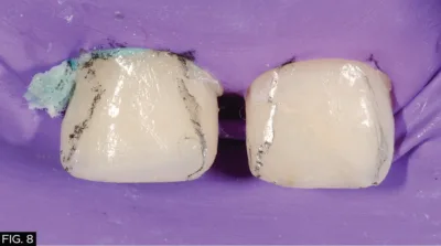 clinical image, restoration, mesial, distal, 