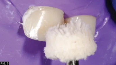 clinical image, restoration, polishing