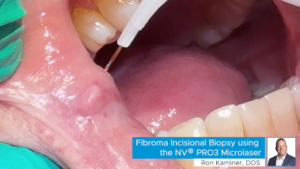 Fibroma Incisional Biopsy using NV Pro3 Microlaser
