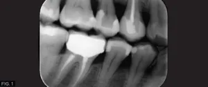 radiograph molar