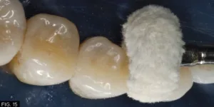 restorative, clinical, polishing