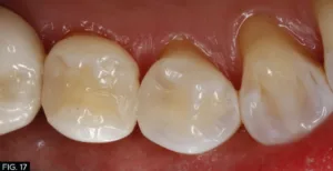 final restoration, Class II, clinical