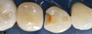 restoration, clinical DO preparation, occlusal preparation, dentin