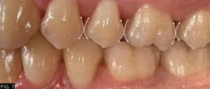 restorative, clinical, proximal tooth anatomy