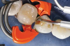 restoration, clinical