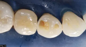 restoration, clinical, Class I